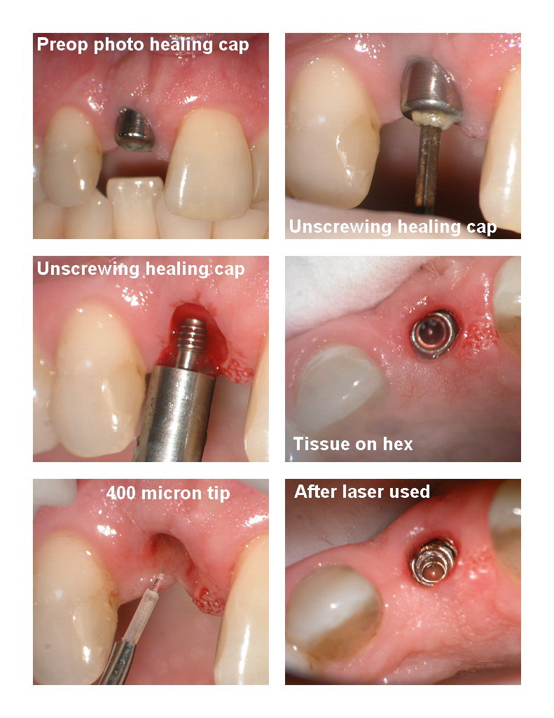 Implant impression pg 1.jpg